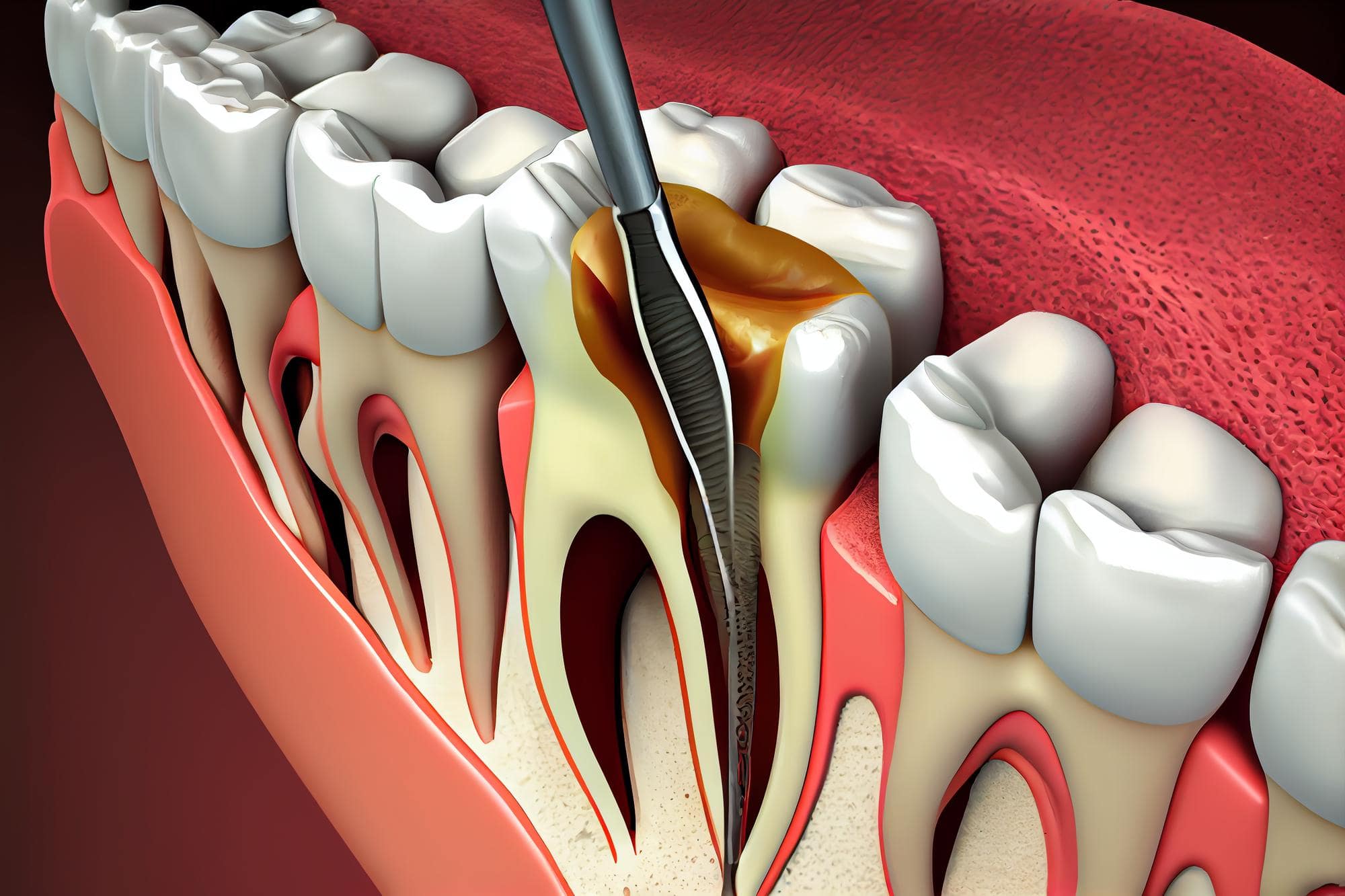 Root canal treatment in Sharjah