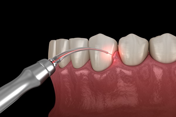 Gum TREATMENT in sharjah