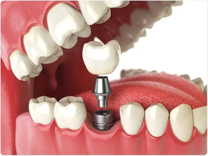Implant dental clinic in Sharjah